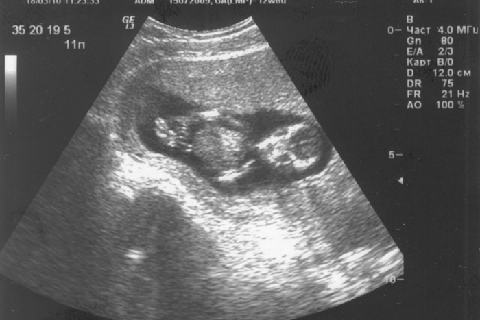 В НИИ ОММ прооперировали ребенка в утробе матери
