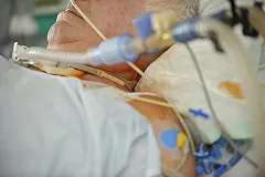 В ожоговом центре Екатеринбурга спасают обожженного кремнием работника «РУСАЛа»