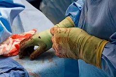 Врачи забыли в животе роженицы салфетку