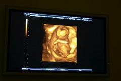 «Беременность протекала с осложнениями»: в перинатальном центре у роженицы в утробе умер ребенок