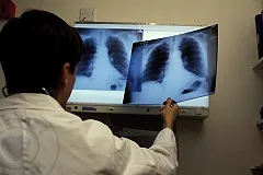 На Урале туберкулезом заражаются дети из благополучных семей