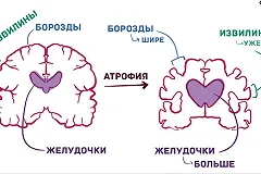 Журнал The Lancet опубликовал «тест» на ранние признаки болезни Альцгеймера