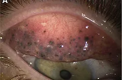 Австралийка четверть века не смывала тушь с глаз и заработала наросты