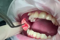 Житель Перми скончался после удаления зуба