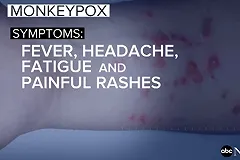 В Нью-Йорке призвали переименовать оспу обезьян из-за чувств чернокожих