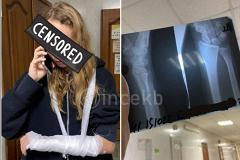 В Екатеринбурге девушка сломала руку во время драки в автобусе