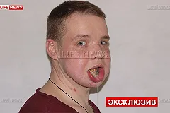 Выжившему в схватке с медведем карпинцу собрали челюсть из костей таза