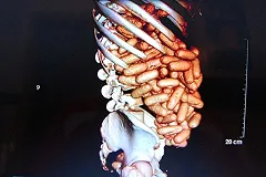 Кусавшийся пассажир рейса Лиссабон-Дублин перевозил в желудке кокаин