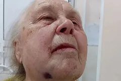 Пожилая свердловчанка рассказала, как ей два часа вырывали зуб мудрости