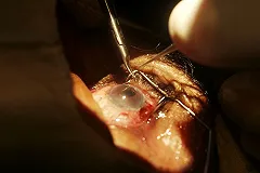 ОКБ № 1 заплатит больше 1 млн рублей пациентке, ослепшей на один глаз