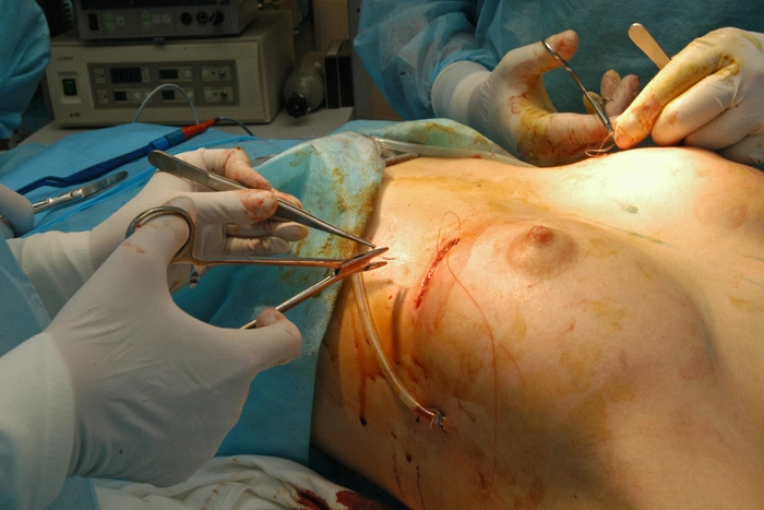 Скальпелем по доллару. Увеличить грудь, поднять веки выгоднее в России