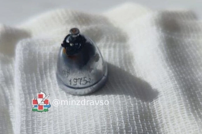 Из лёгких екатеринбуржца извлекли вросший в них колокольчик