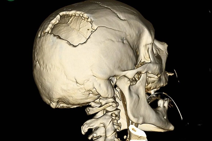 Стрела башенного крана пробила череп свердловчанина