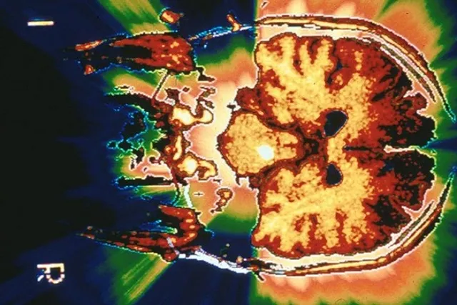 Впервые найдены группы генов, управляющие интеллектом человека