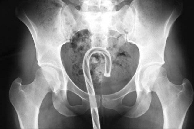 В США составили список застрявших в людях предметов и упорядочили по отверстиям