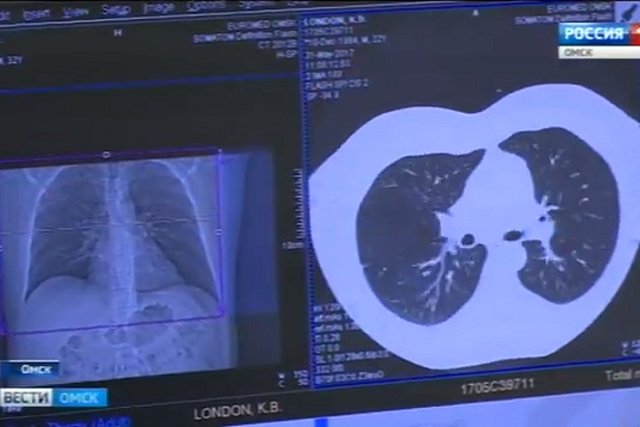 Показания для проведения КТ ужесточились в Свердловской области