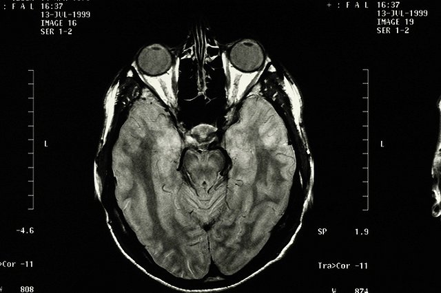 Физические упражнения приводят к реальным изменениям мозга, показал анализ