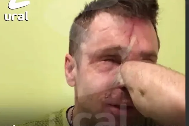 Екатеринбургские хирурги «собрали» лицо подорвавшемуся на мине в Донбассе военнослужащему