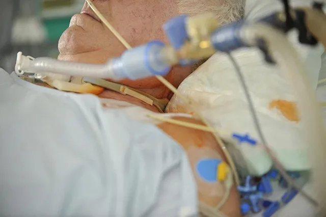 В ожоговом центре Екатеринбурга спасают обожженного кремнием работника «РУСАЛа»