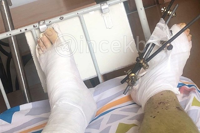 Купание екатеринбуржца в Исети привело к сильнейшим травмам