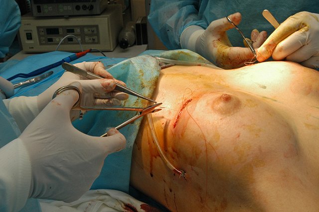 Скальпелем по доллару. Увеличить грудь, поднять веки выгоднее в России