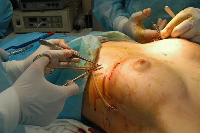 Скальпелем по доллару. Увеличить грудь, поднять веки выгоднее в России