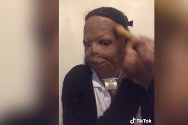 18-летняя британка с обожженым лицом стала популярным бьюти-блогером