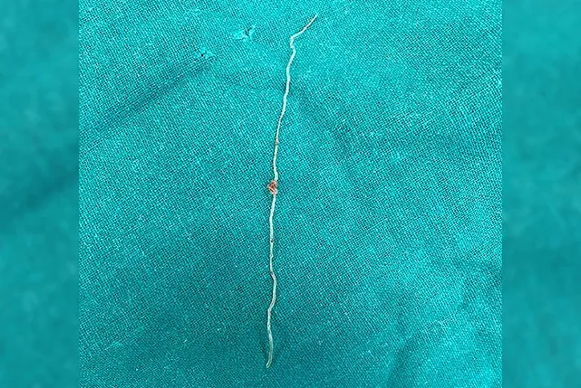 В щеке россиянки после укуса комара завелся паразит