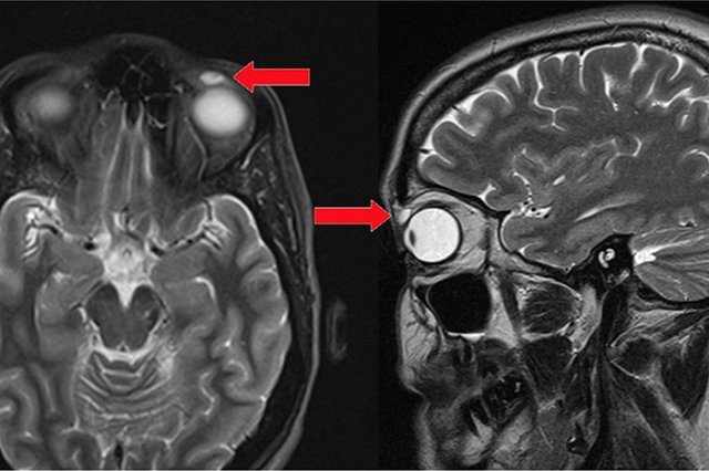 У британки из-под века вытащили линзу спустя 28 лет