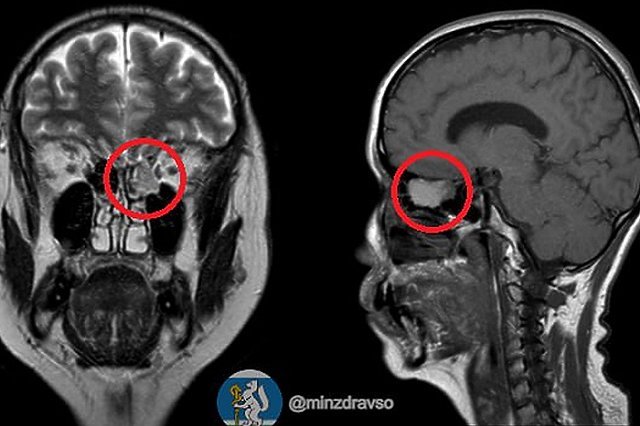 Свердловские врачи провели уникальную операцию, удалив опухоль без проколов
