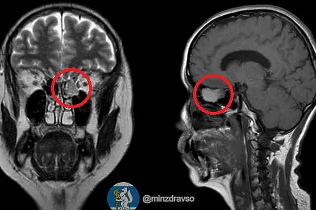 Свердловские врачи провели уникальную операцию, удалив опухоль без проколов
