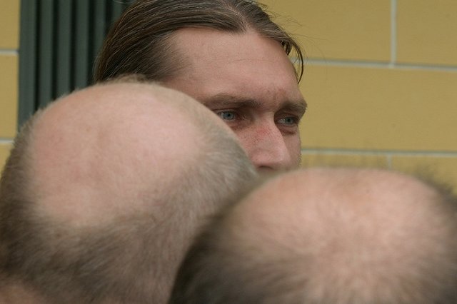 Екатеринбуржцы лысеют чаще, чем жители Москвы и Питера. «В Сочи надо переезжать»