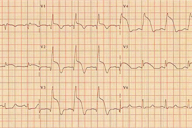 Названа неожиданная причина ранней смерти
