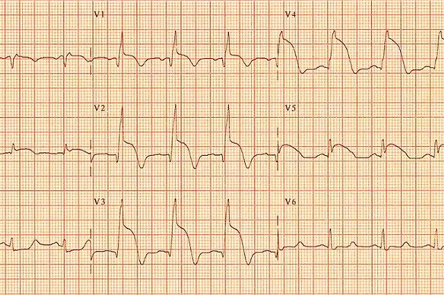 Названа неожиданная причина ранней смерти