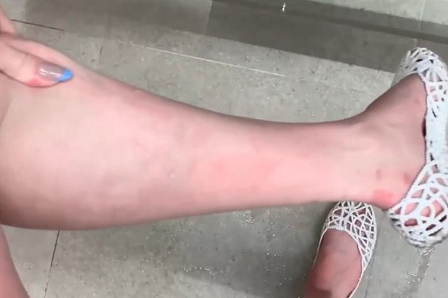 Екатеринбуржцы покрылись сыпью после купания в бассейне в новых термах