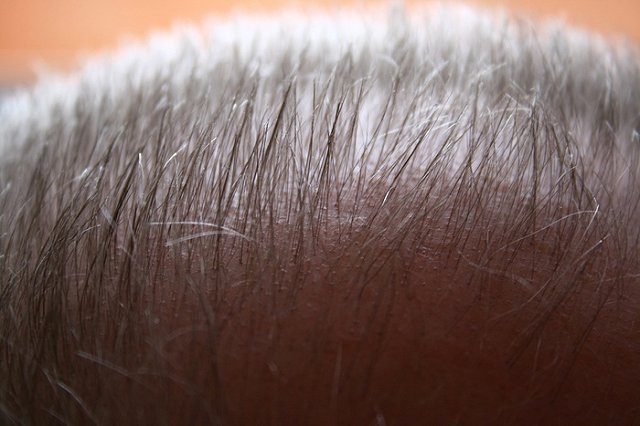 Выдергивание волос оказалось эффективным средством от облысения