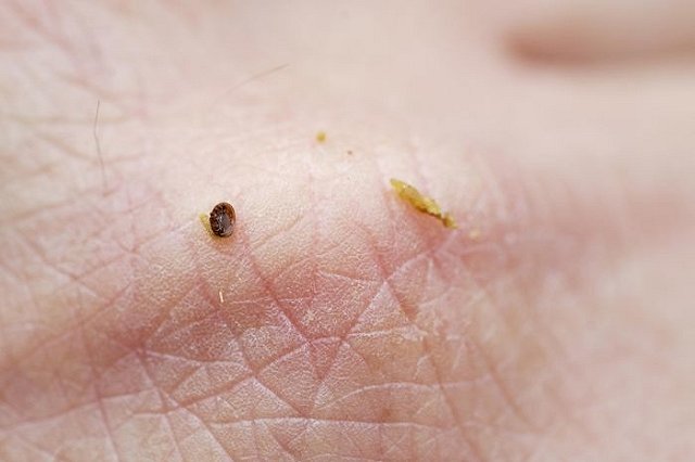 Клещи покусали уже более 7000 человек в Свердловской области