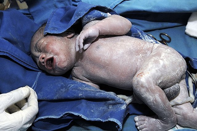 Свердловчанка отсудила 2,5 млн у больницы, превратившей ее ребенка в инвалида