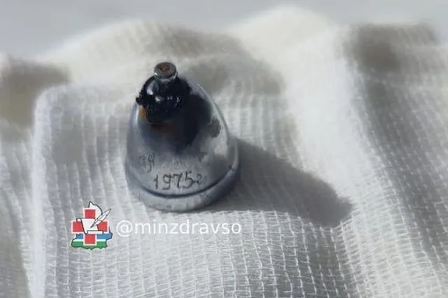 Из лёгких екатеринбуржца извлекли вросший в них колокольчик