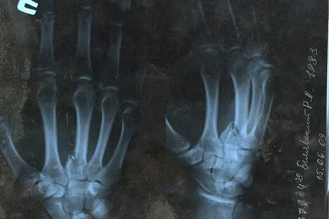 Уральцу грозит до десяти лет колонии за сломанный палец полицейского