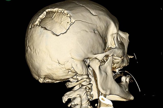 Стрела башенного крана пробила череп свердловчанина