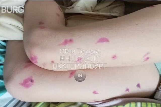 Екатеринбуржцы искупались в озере на Шарташе и покрылись зудящими пятнами