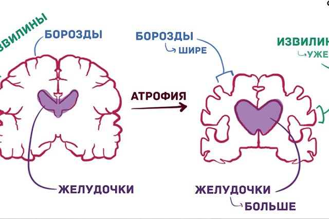 Журнал The Lancet опубликовал «тест» на ранние признаки болезни Альцгеймера