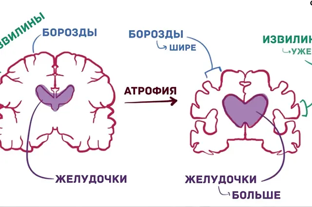 Журнал The Lancet опубликовал «тест» на ранние признаки болезни Альцгеймера