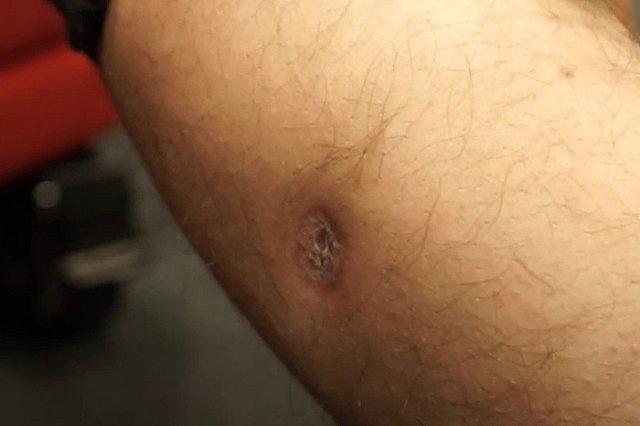 Раненного во время спецоперации свердловчанина выписали из госпиталя с пулей в ноге