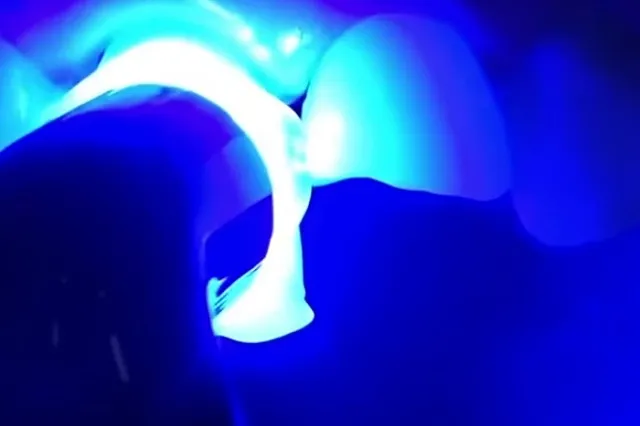 «Я его слепила из того, что было». Стоматологи объяснили, чем опасны пломбы с маркетплейса