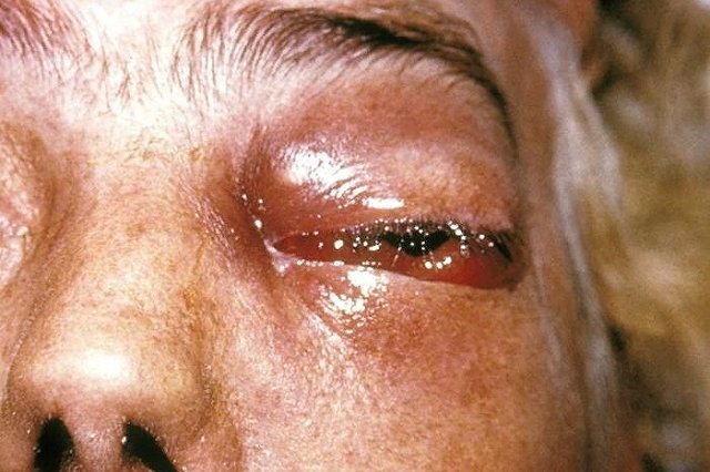 В Индии большинству зараженных «черной плесенью» удалили глаза