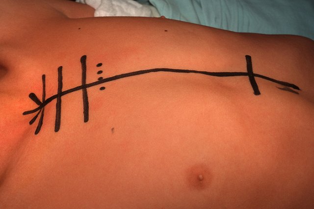 Одному из нападавших на дом Шишова хирурги проводят пятую по счету операцию