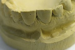 После протезирования зубов у женщины пропал слух