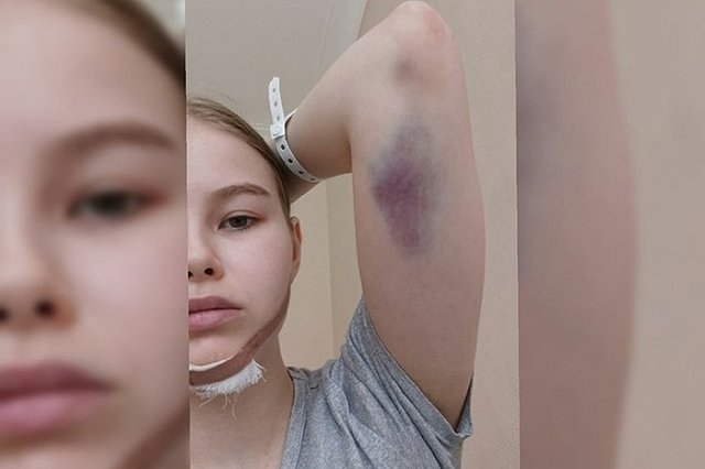 В Екатеринбурге девушка получила перелом челюсти при падении с электросамоката